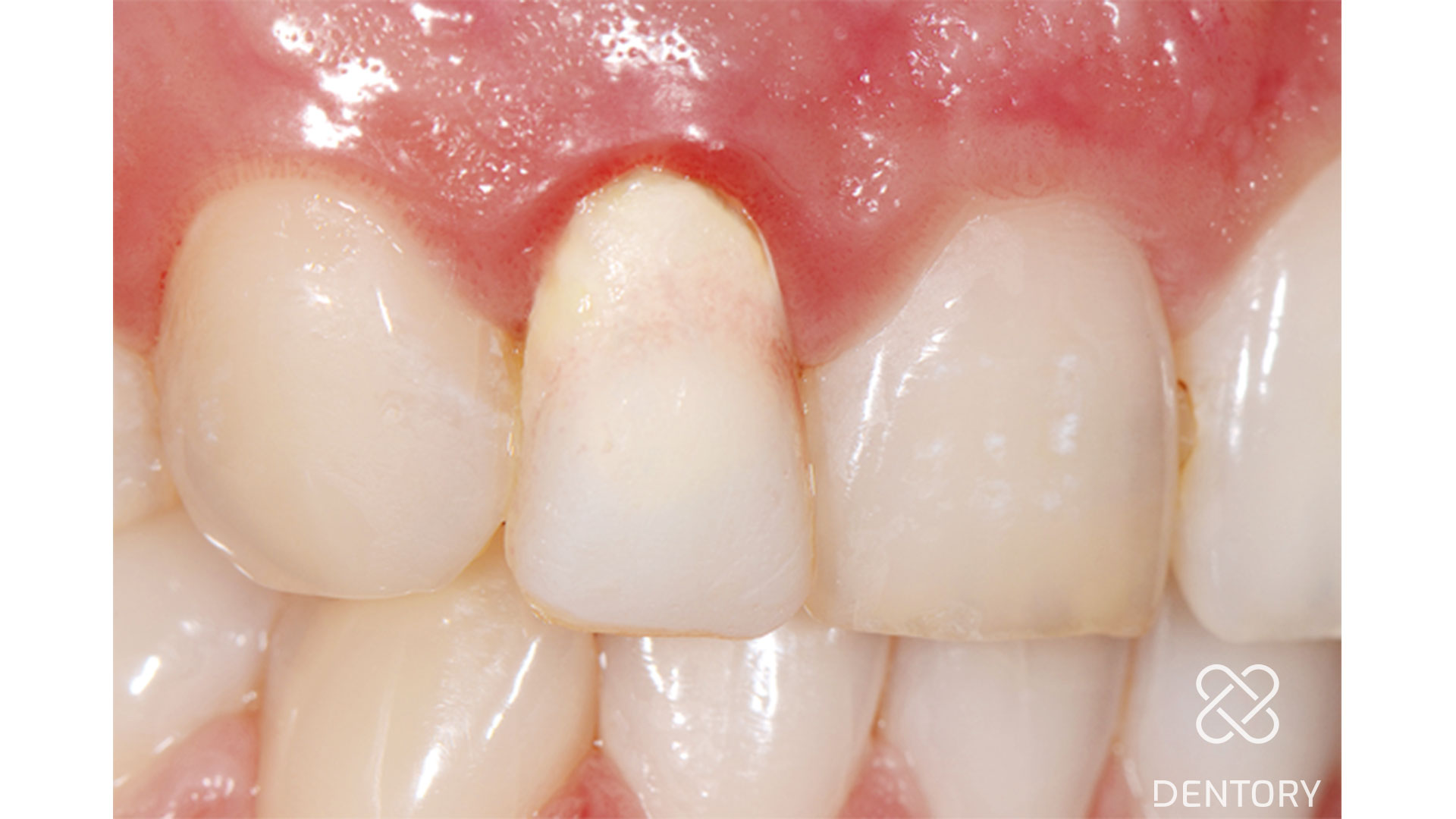 Ausgangssituation: Zahn 12 provisorisch versorgt, tief reichender Defekt
