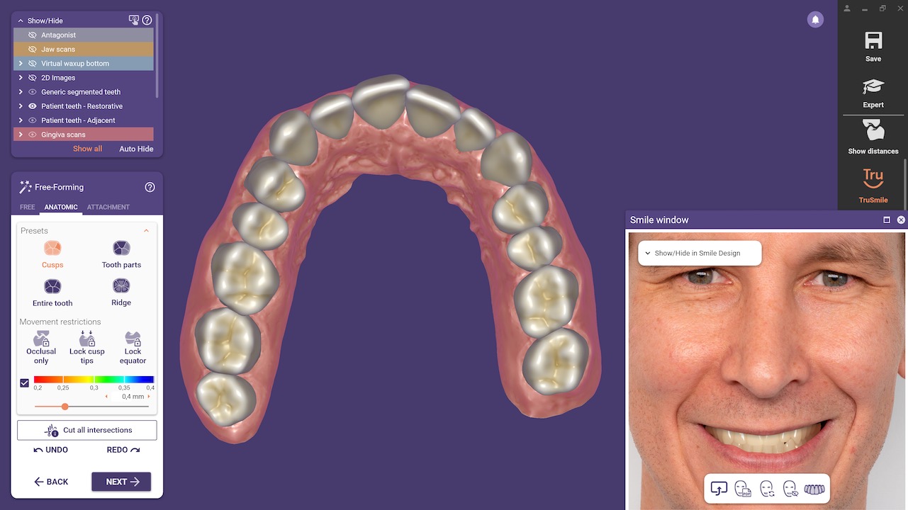 Mit dem Smile-Creator-Modul können Anwender nun für realistischere Ergebnisse eine virtuelle Gingiva designen und ein Lächeln gestalten, das auf den natürlichen Zähnen des Patienten basiert.
