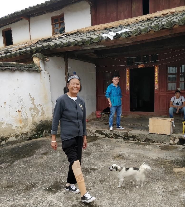 Frau mit neuer  Prothese in Lu Feng, Yunnan.