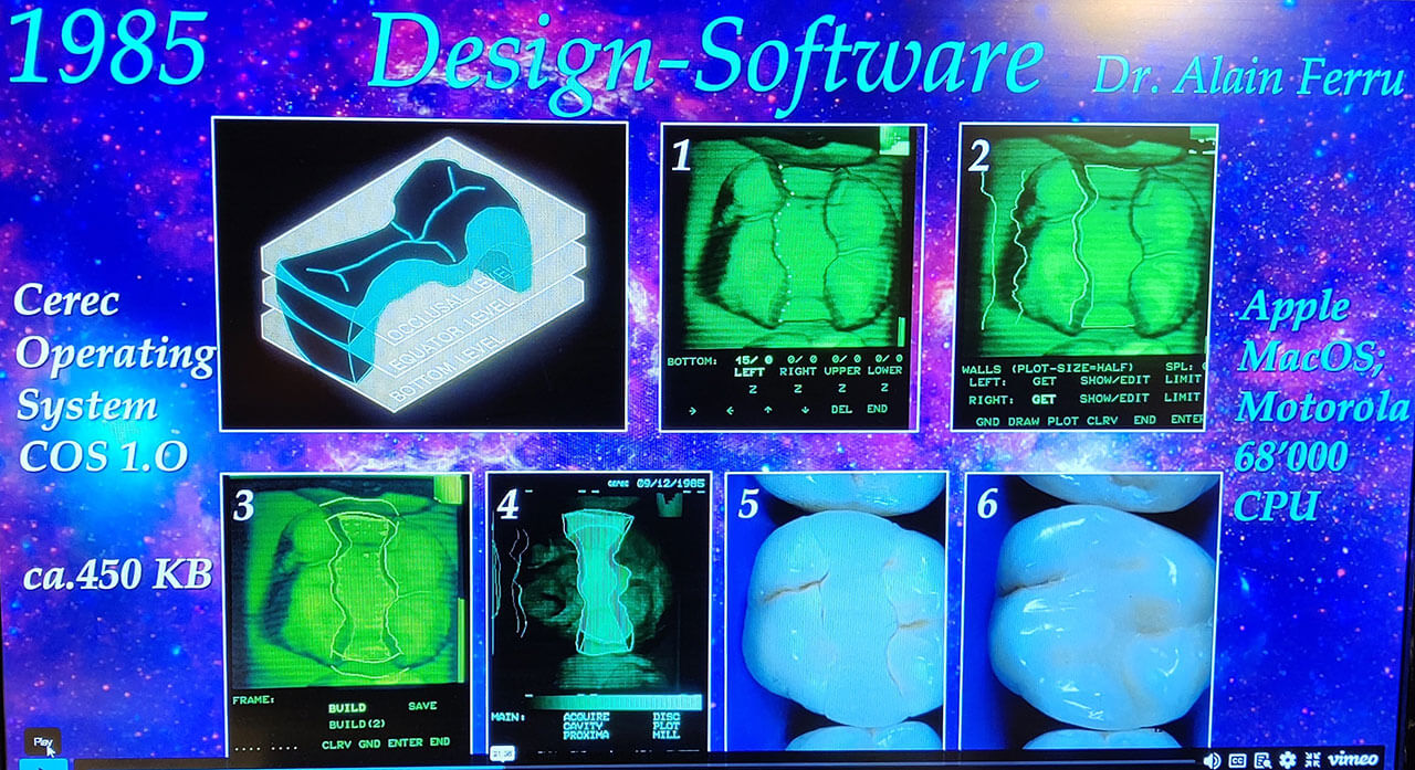 Abb. 2: Die erste Cerec-Software, 1985 von Dr. Alain Ferru entwickelt, übertrug die Scandaten in den Konstruktions- und Ausschleifmodus. 