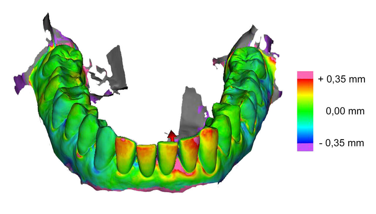 Abb. 1: Differenzanalyse zur Erfassung von Erosion, Abrasion, Zahnwanderungen, Zahnfleischveränderungen, Abplatzungen durch Überlagerung von zeitlich versetzten Intraoralscans. Visualisierung der Proklination der Zähne 33-42 von Ganzkiefer-Scans.