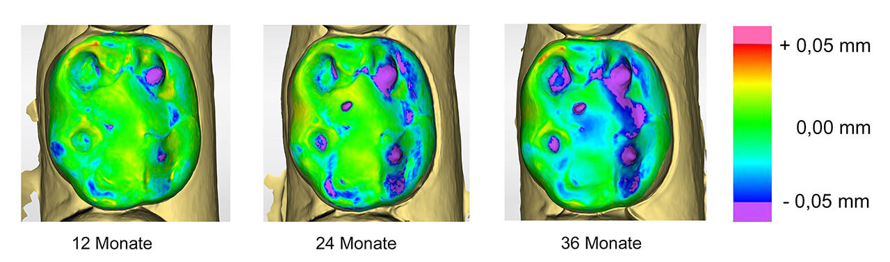 Abb. 2: Überlagerung von Intraoralscans mit jeweils 12 Monaten Abstand zum Monitoring und zur Visualisierung des okklusalen Zahnhartsubstanzverlustes.
