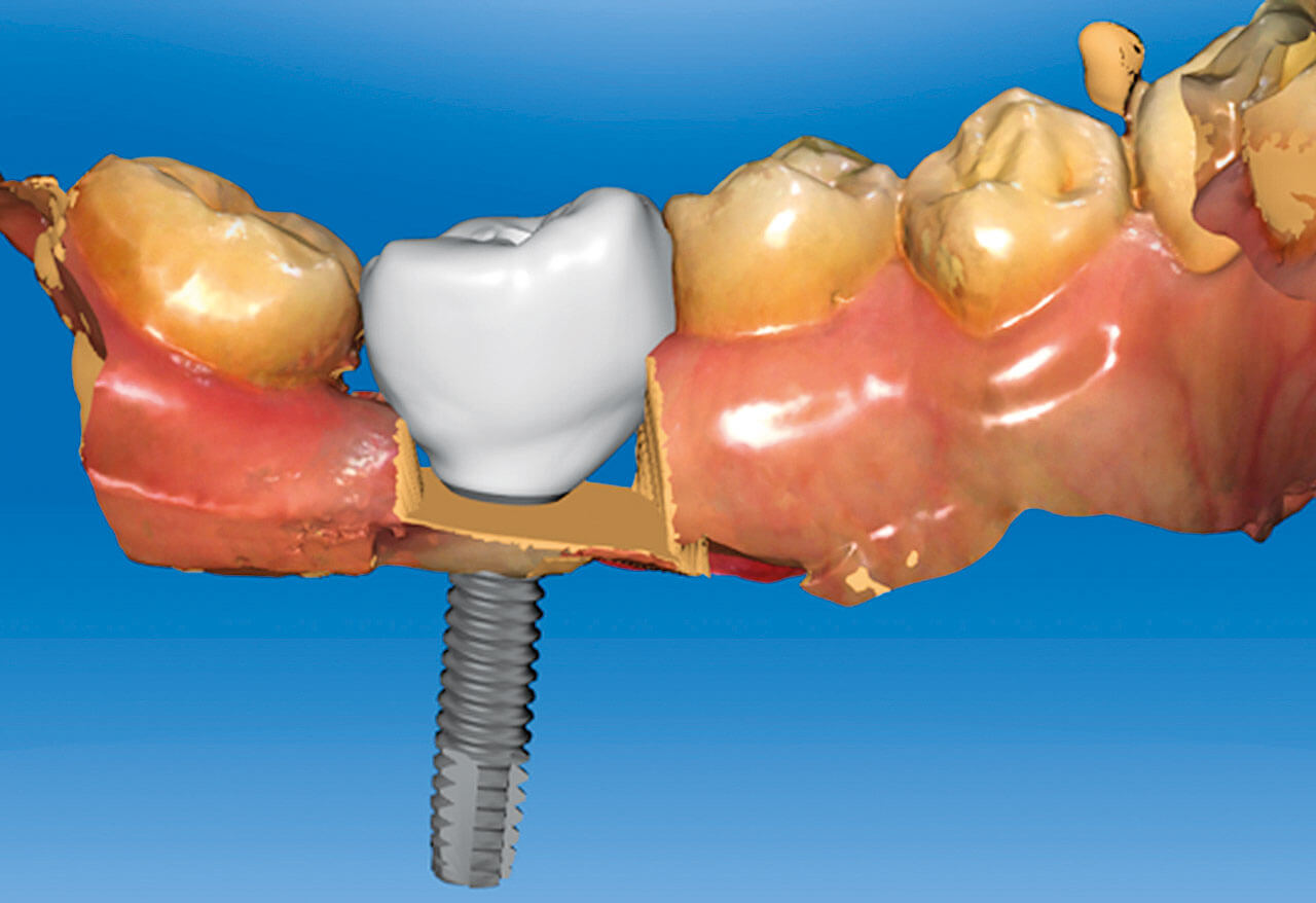 Abb. 4: Virtuelle Planung und Gestaltung einer implantatgetragenen Krone.