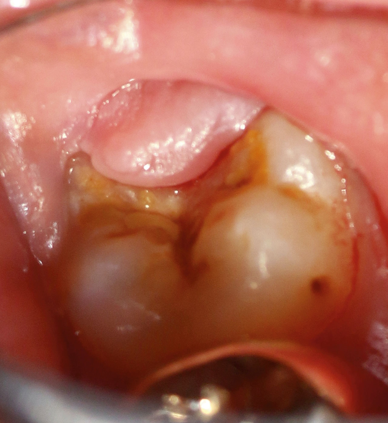Abb. 7 Gewebelappen (Operculum) über dem teilweise durchgebrochenen Zahn 38. Der Patient beklagte rezidivierende Entzündungen des überhängenden Gewebes