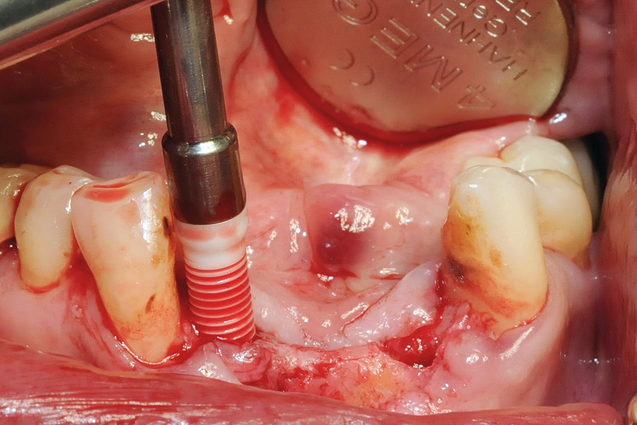 Abb. 15 Implantatinsertion