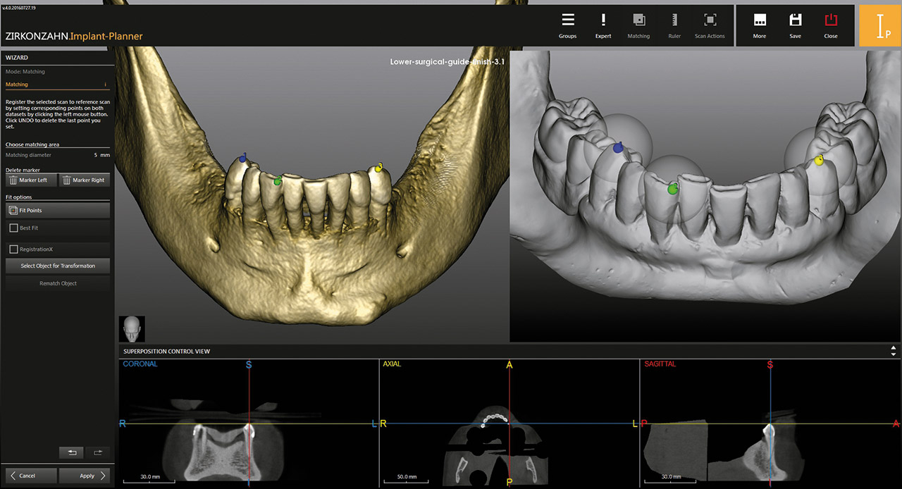 Abb. 4 Die Zahnaufstellung nach dem Matching auf Modellscans, Gesichtsscans und DICOM-Daten im Zirkonzahn.Implant-Planner.