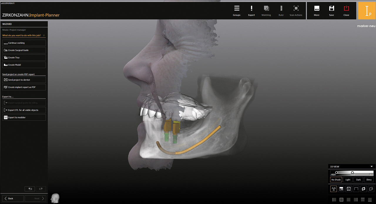 Abb. 22 bis 24 Bevor die Bohrschablone geplant werden kann, gibt der Zahnarzt die Implantatplanung frei.