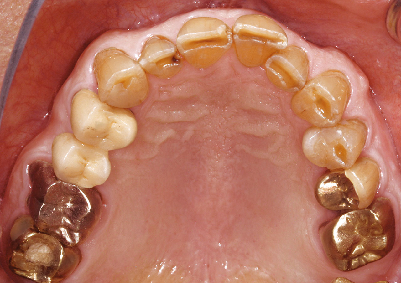 Abb. 1a Klinische Situation bei der Erstvorstellung: generalisiert zervikale kariöse Läsionen, epigingival frakturierte Zähne 35 und 36, ausgedehnte Kronenrandkaries am Zahn 47 (Zustand nach Entfernung der Krone).
