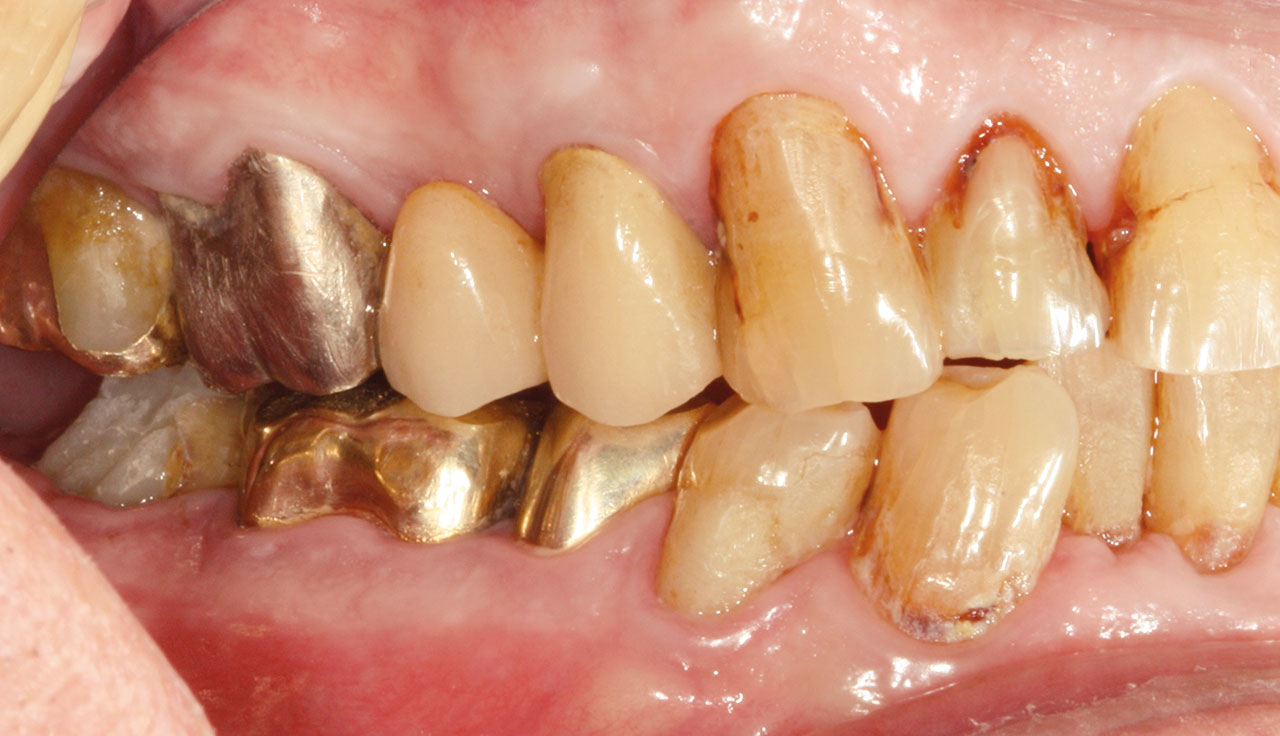 Abb. 1b Klinische Situation bei der Erstvorstellung: generalisiert zervikale kariöse Läsionen, epigingival frakturierte Zähne 35 und 36, ausgedehnte Kronenrandkaries am Zahn 47 (Zustand nach Entfernung der Krone).