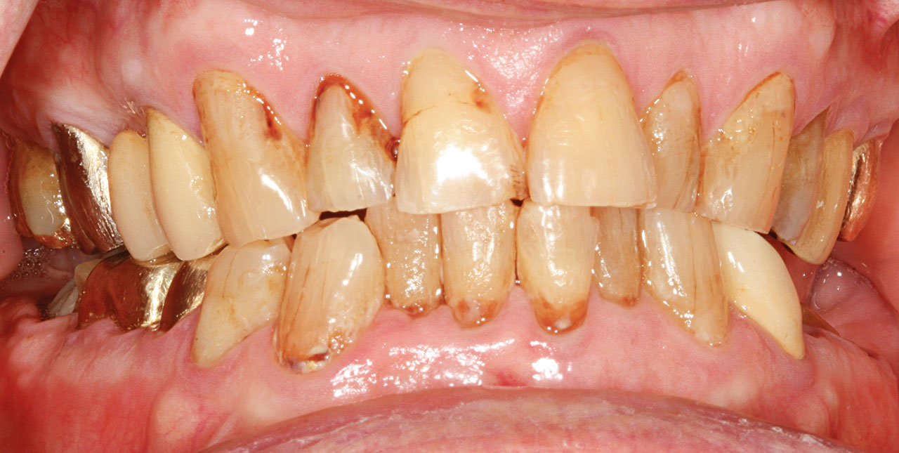 Abb. 1c Klinische Situation bei der Erstvorstellung: generalisiert zervikale kariöse Läsionen, epigingival frakturierte Zähne 35 und 36, ausgedehnte Kronenrandkaries am Zahn 47 (Zustand nach Entfernung der Krone).