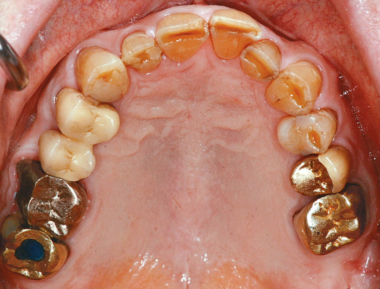 Abb. 7a Klinische Situation nach prothetischer Versorgung des prämolarisierten Zahnes 36 und des Zahnes 35 mit verblockten Goldkronen sowie Verblockung des hemisezierten Zahnes 47 mit dem Zahn 46.