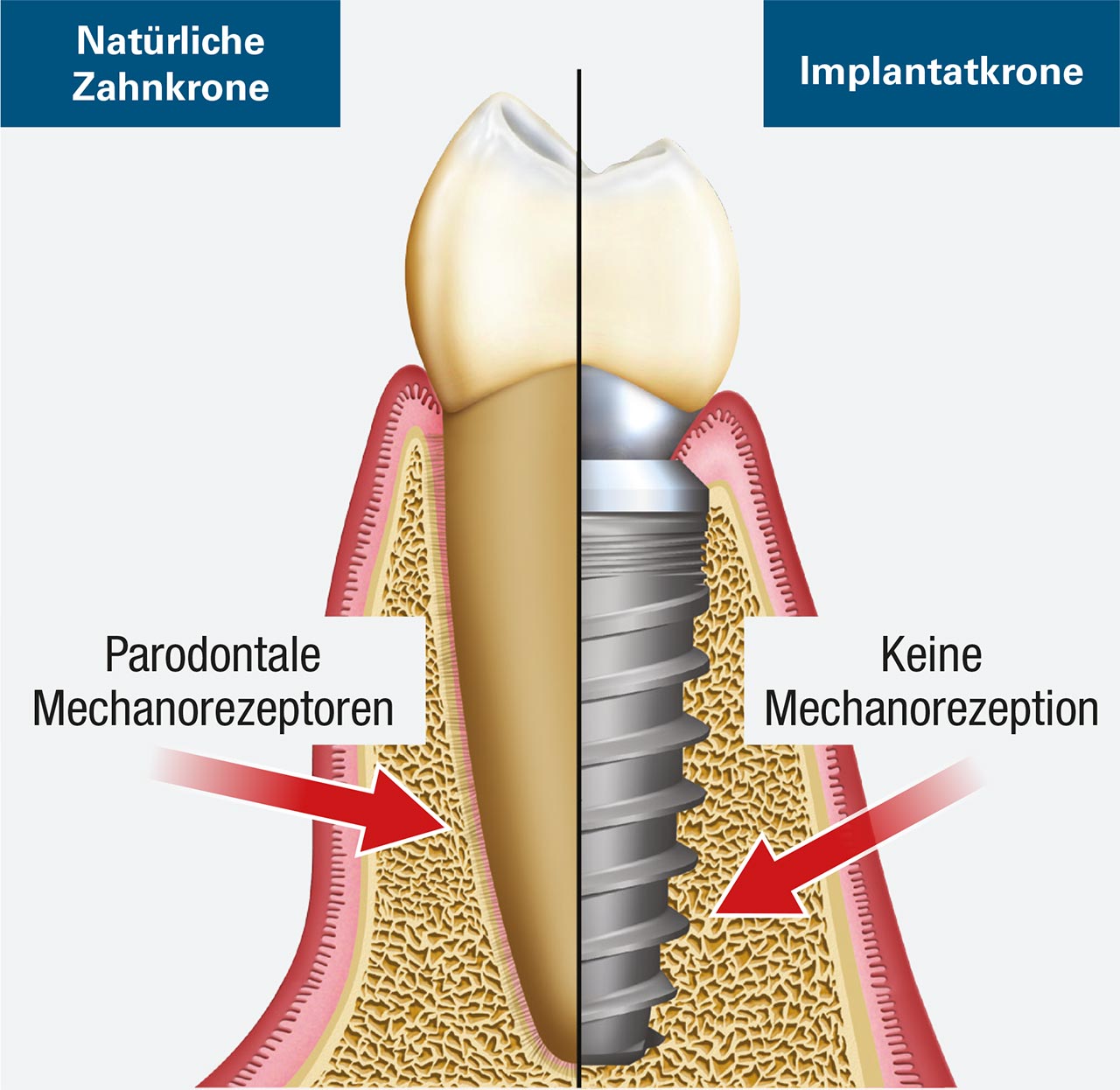 Abb. 1 Der natürliche Zahn enthält ein Parodontalligament (PDL), während beim Implantat ein solches PDL fehlt und eine direkte Knochen-Schnittstelle vorhanden ist.