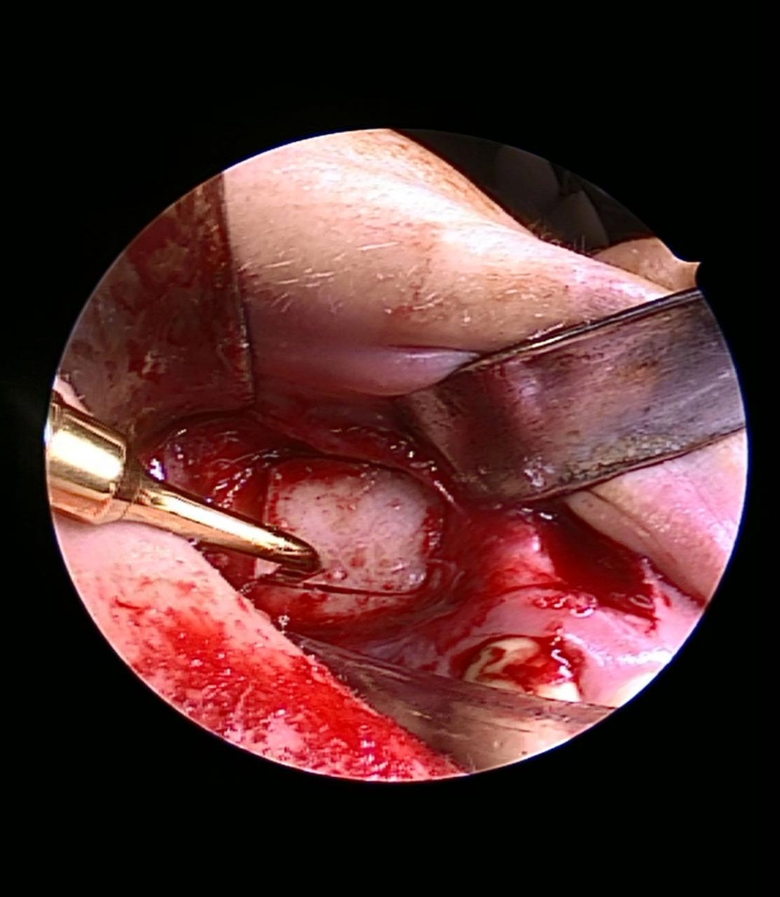 Abb. 3: Das intraoperative Bild zeigt den Zugang zum Sinus maxillaris rechts. Mittels Piezosurgery erfolgt die Bildung eines Knochenfensters modo Abello.
