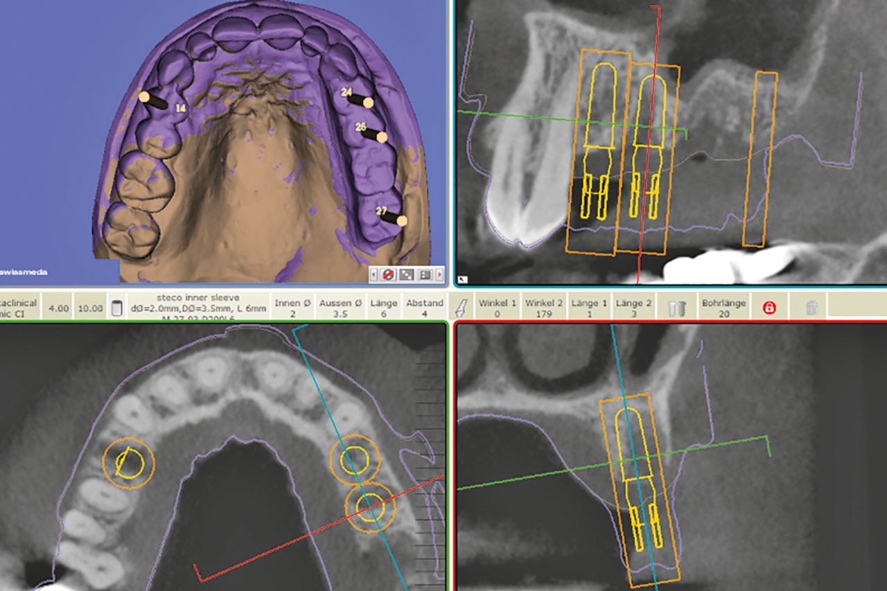 Abb. 4 Virtuelle Implantatplanung anhand prothetischer Vorgaben sowie anatomischer Voraussetzungen.