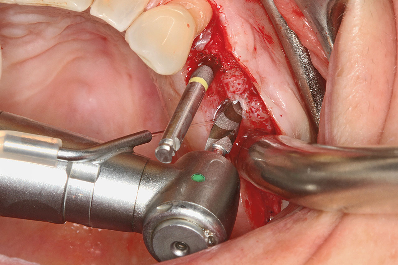 Abb. 8  Implantatbettaufbereitung entsprechend dem Bohrprotokoll.