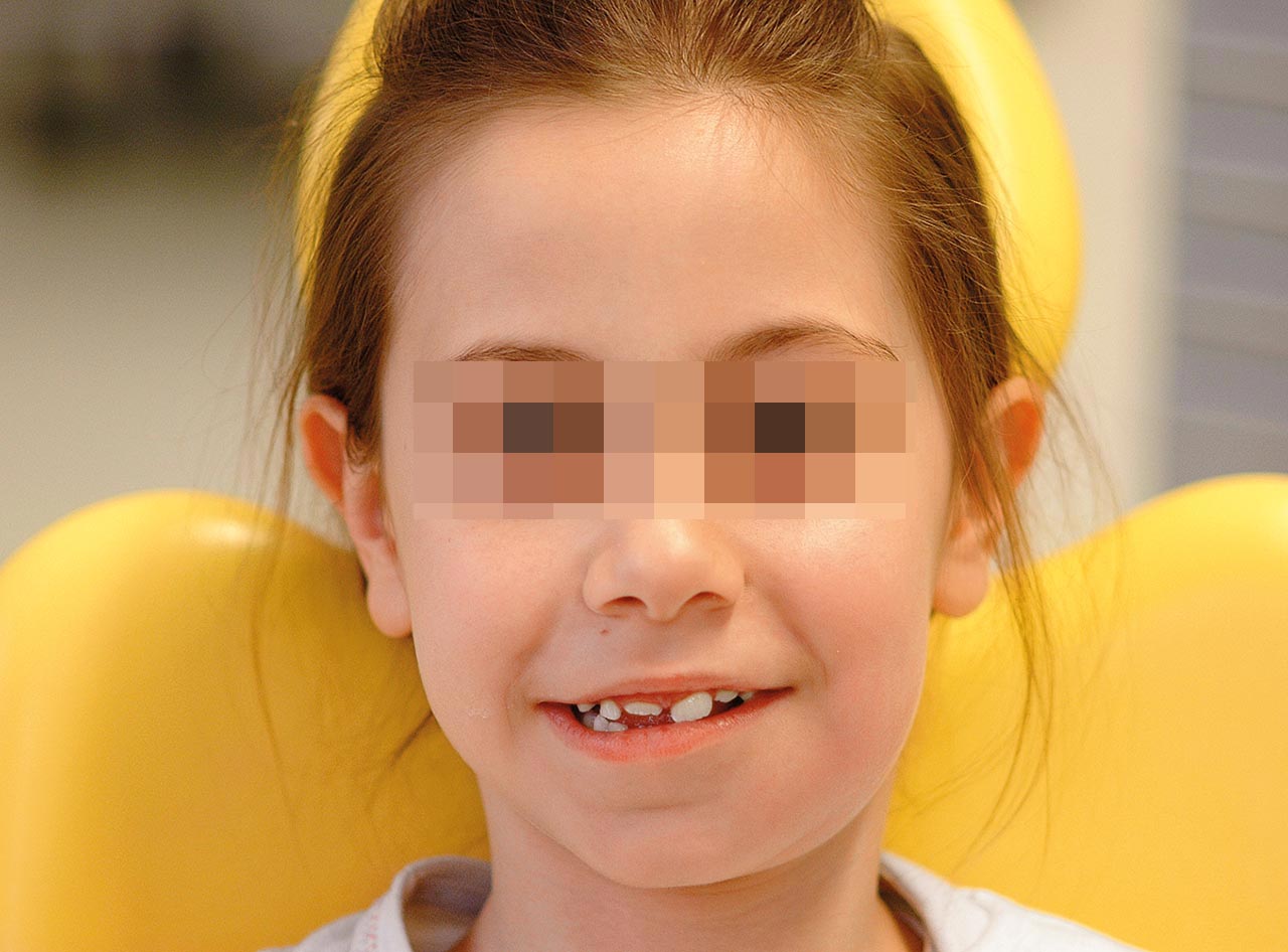 Abb. 2a bis c: Submuköser Abszess am Zahn 74 nach füllungstherapeutischer Behandlung einer profunden kariösen Läsion bei einer 7 1/2-jährigen Patientin. Pulpanahe Läsionen an Milchzähnen können häufig mit einer irreversiblen Pulpitis assoziiert sein. Nach symptomatischer Antibiotikatherapie war die Entfernung des Zahnes einige Tage später in Lokalanästhesie möglich.
