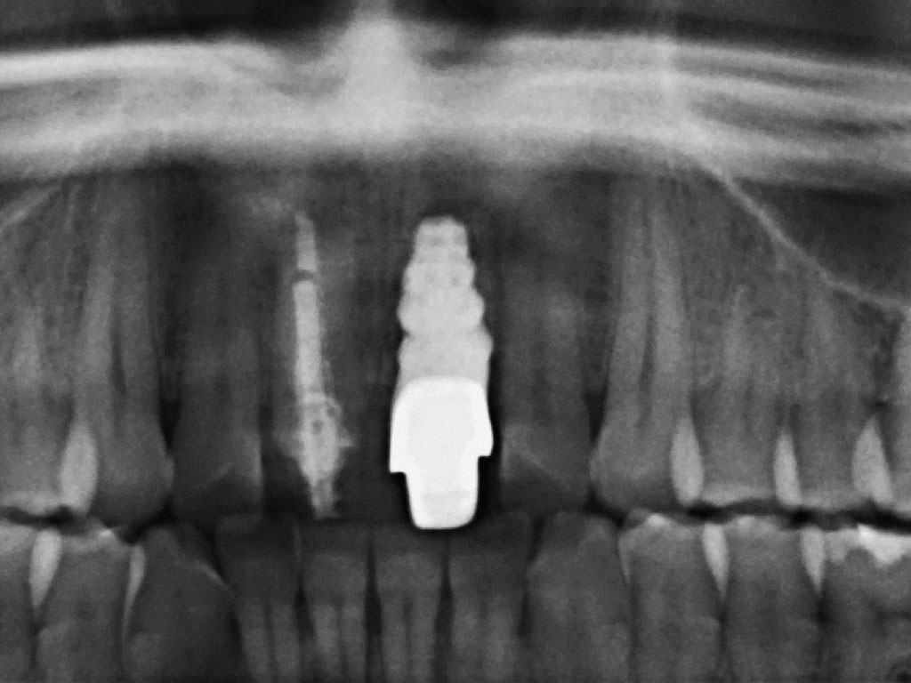 Abb. 28 und 29 Panorama-Röntgenaufnahme mit Zahn 21 direkt nach der Insertion (a) und nach 12 Monaten in situ (b).