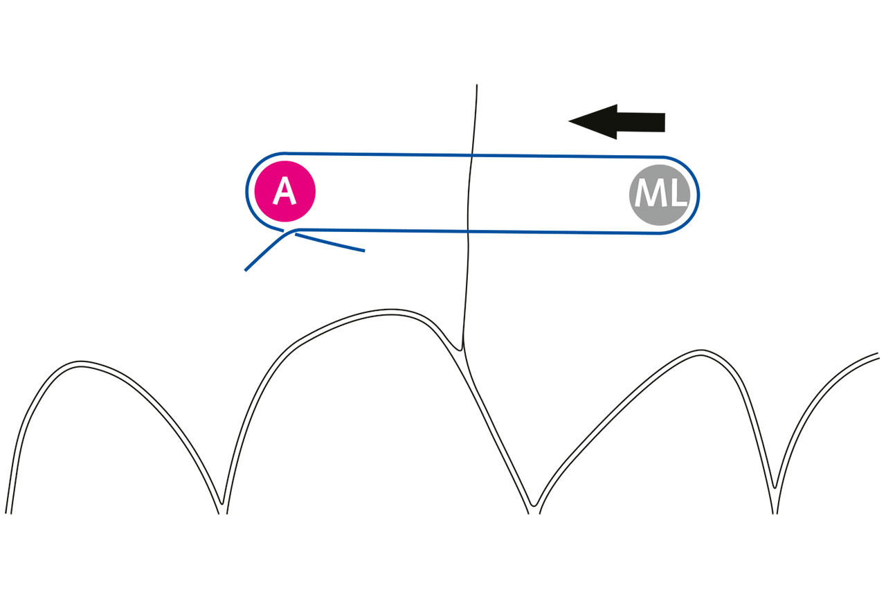 Abb. 3 Schematische Darstellung der Lappenstabilisierung (Pfeil) durch eine Einzelknopfnaht von einem mobilen Lappenanteil zu einem unbeweglichen Anker, in diesem Fall der Gingiva im befestigten Lappenanteil (ML = mobiler Lappen, A = Anker).