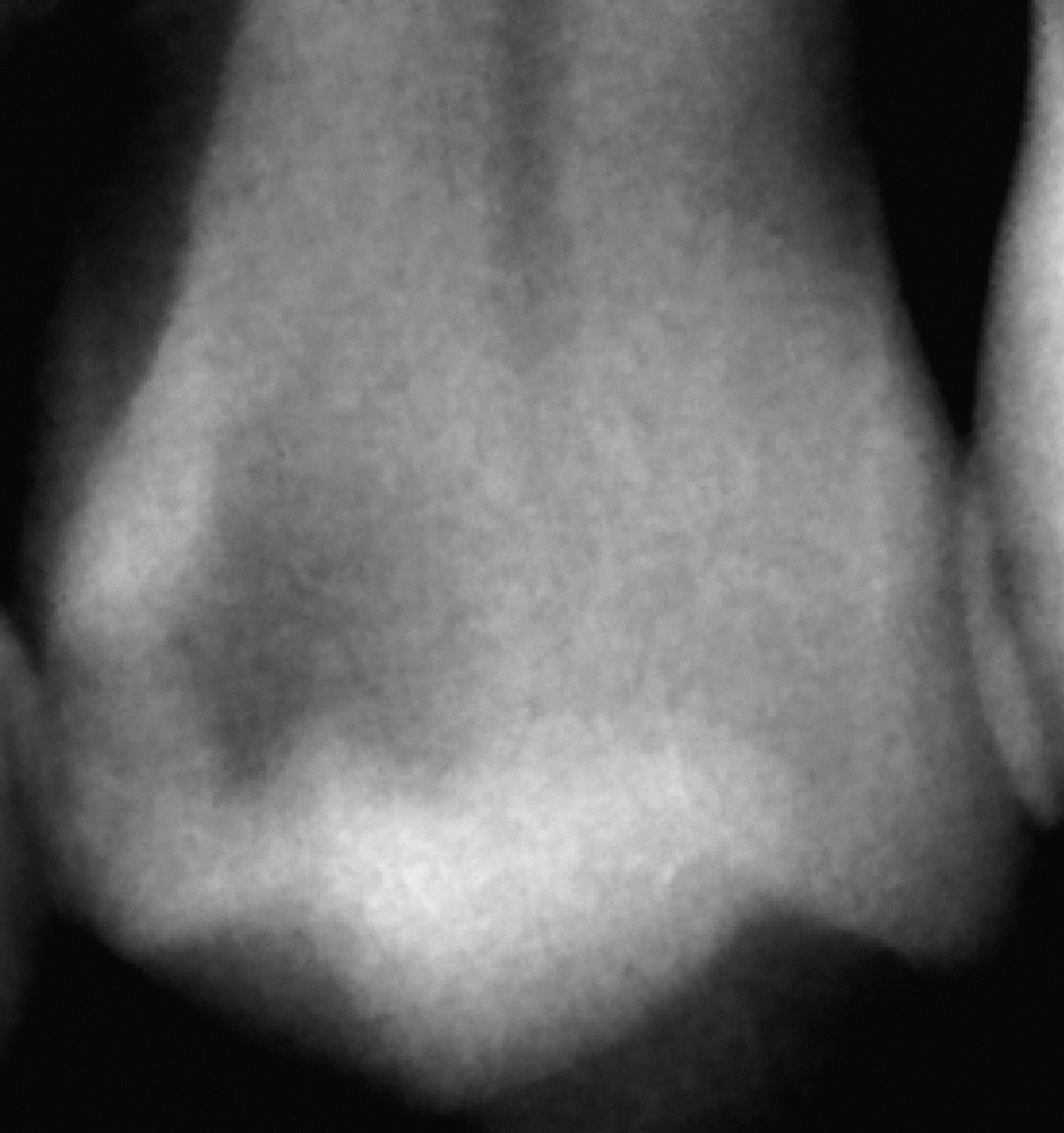 Abb. 5 Selektive Exkavation in einem vitalen Prämolaren eines 41-jährigen Patienten. Die Pulpa des Zahnes war sensibel und zeigte keine Zeichen für eine irreversible Pulpitis. Die kariöse Läsion war radiologisch bis in das innere Dentindrittel ausgedehnt, ...