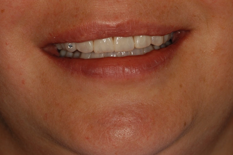 Lippenbild nach Abschluss der Behandlung (Foto: Dr. Martin von Sontagh)