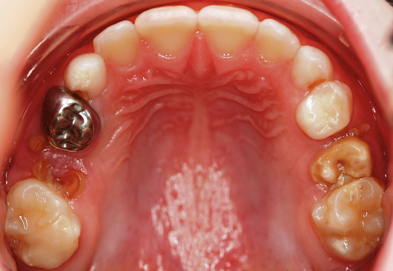 Abb. 12  Turner-Zahn 25 und atypische Restauration an 16. Anamnestisch wurde eine eitrige Entzündung im OK links beschrieben. Da noch ein Wurzelrest 65 zu sehen ist, sowie 55 ebenfalls tief zerstört ist, liegt der Verdacht nahe, dass eine eitrige apikale Milchzahnostitis (vgl. Abb. 6) zu der Schädigung des Ersatzzahnkeims 25 geführt hat. (Foto: Schmoeckel)