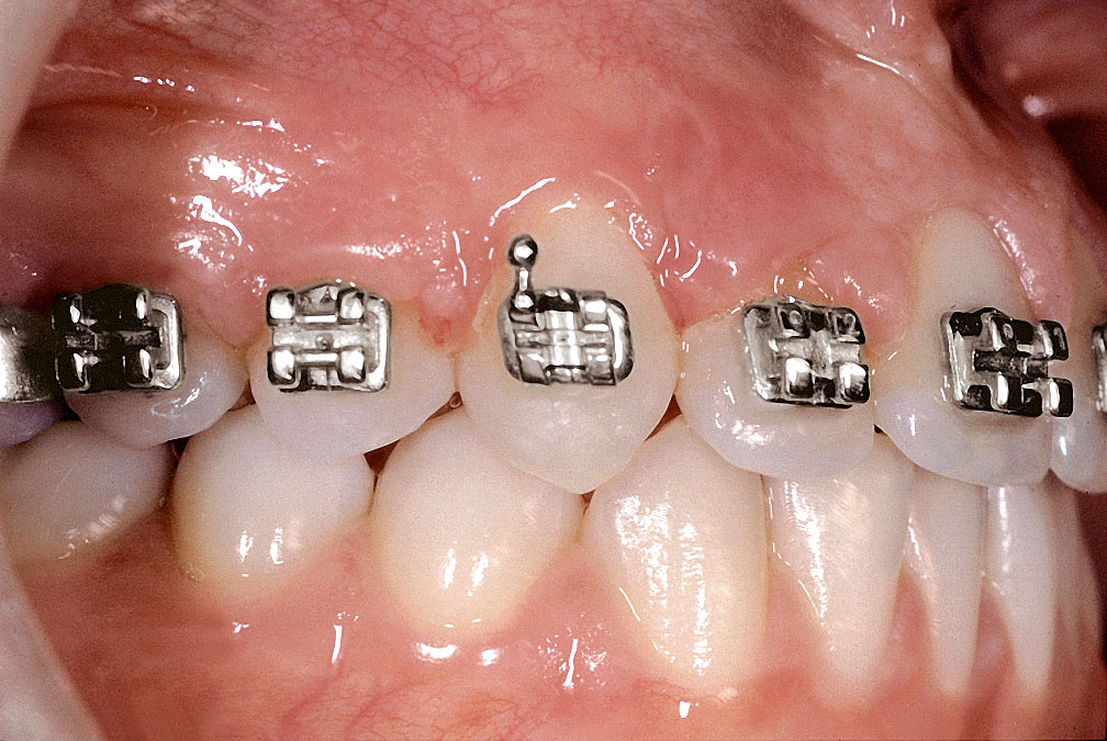 Abb. 7 Nach 15 Monaten aktiver KFO-Therapie ist Zahn 13 eingereiht.