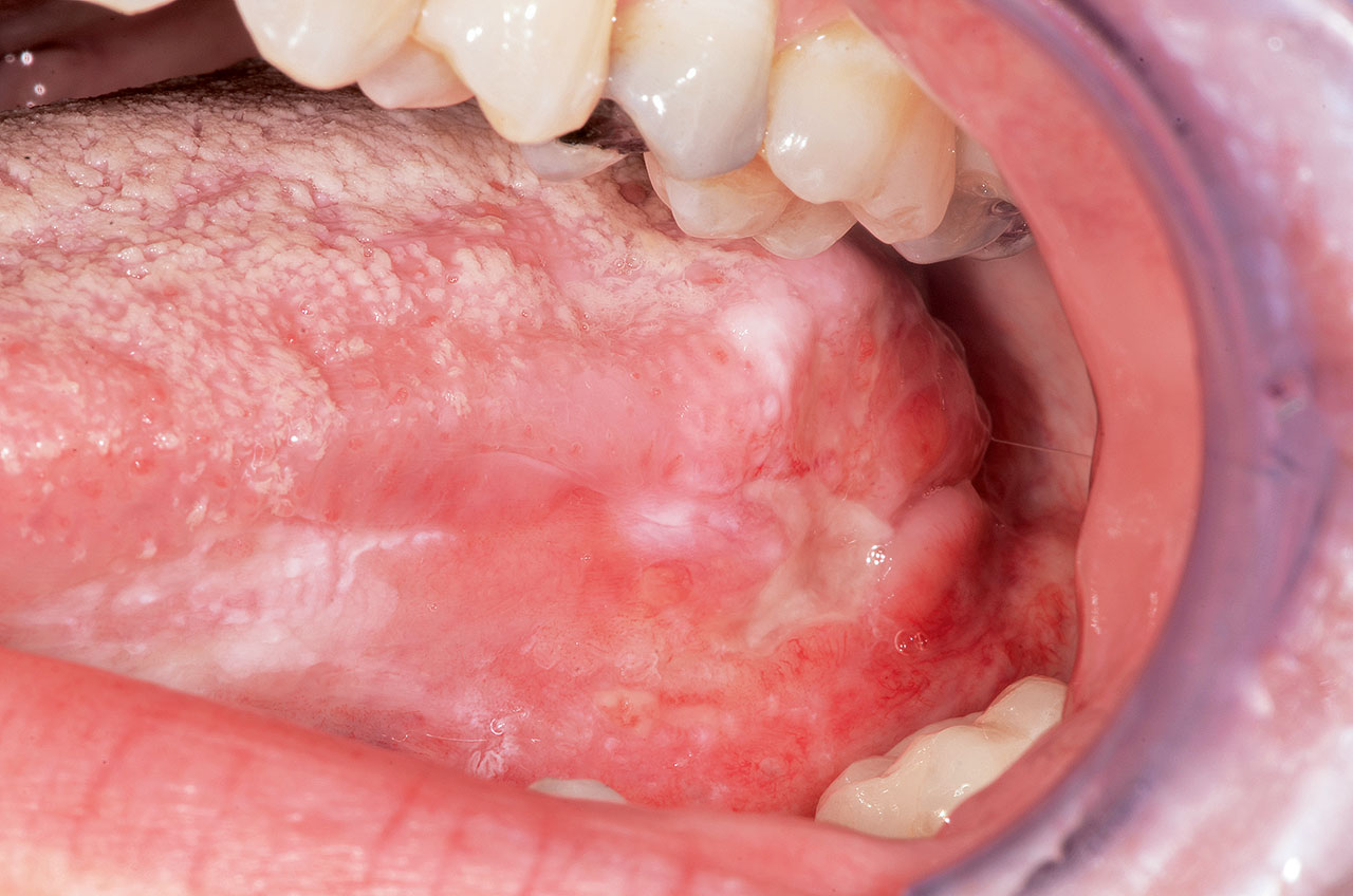 Abb. 5 Das Ulkus am linken Zungenrand dieser 48-jährigen Patientin (Nichtraucherin) wurde mehrere Wochen lang als Major-Aphthe missdeutet. Die im Anschluss an eine Inzisionsbiopsie vorgenommene histopathologische Untersuchung be- stätigte ein aggressives Plattenepithelkarzinom. Die weiteren Untersuchungen ergaben, dass die regionalen Lymphknoten beidseits Metastasen aufwiesen und sogar Fernmetastasen vorhanden waren (cT4a cTN2b cM1).