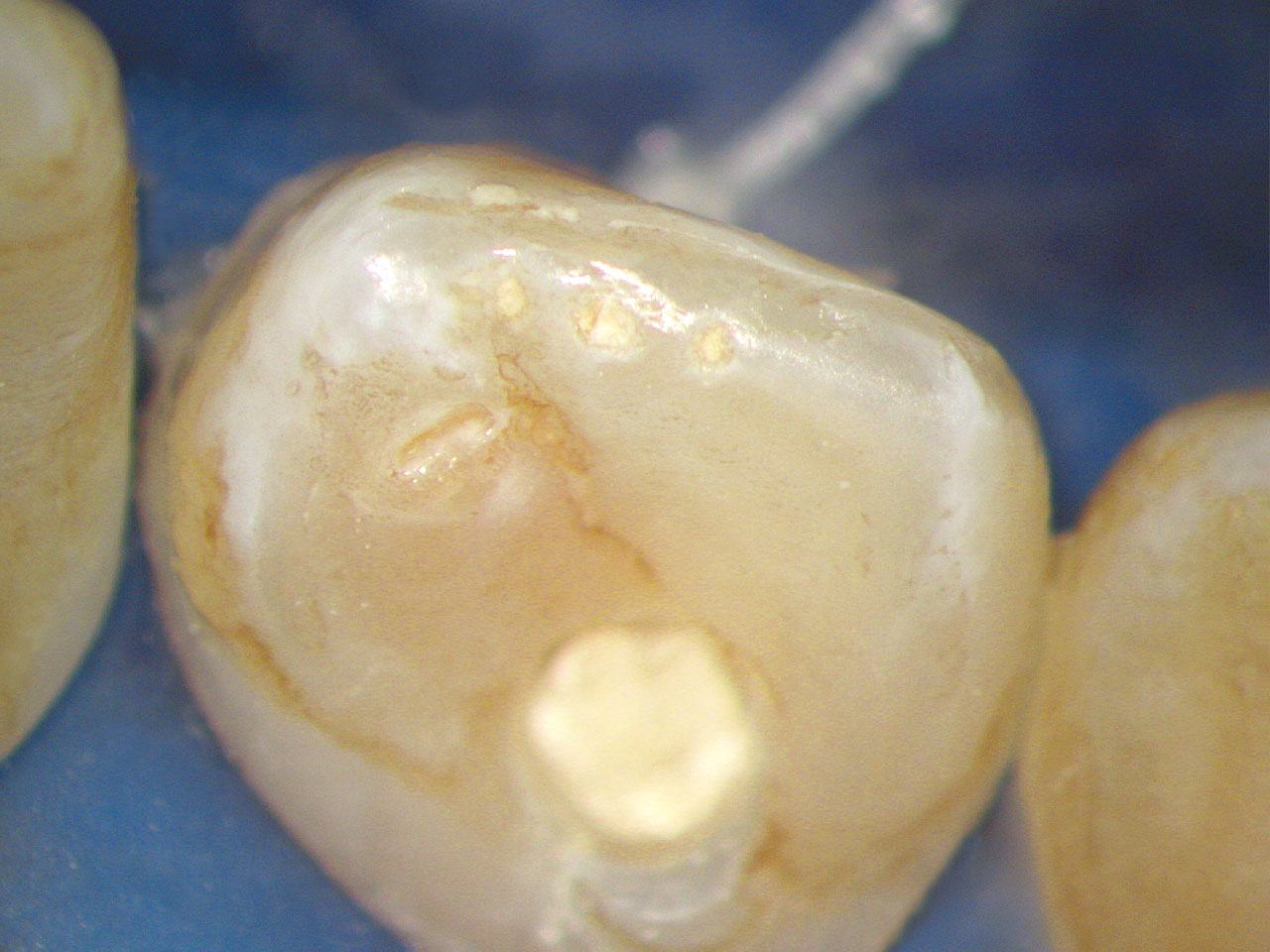 Abb. 14 Schmelz­dysplasien am Zahn 12 mit einer atypischen Kavität auf der palatinalen Kronenfläche als Hinweis auf einen Dens invaginatus.