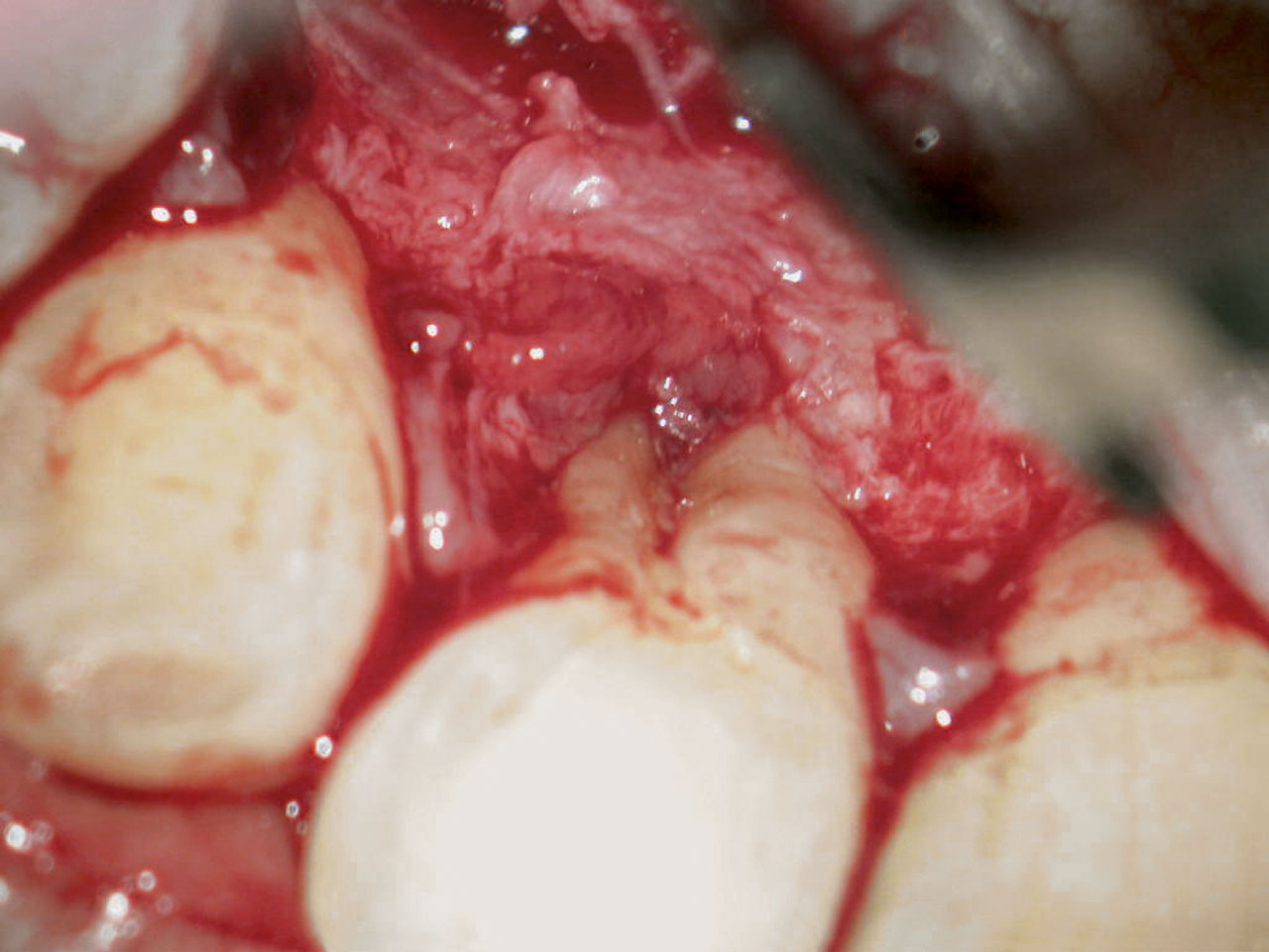 Abb. 18 Nach der chirurgischen Exploration der palatinalen Wurzeloberfläche kann die Verdachtsdiagnose einer Vertikalfraktur verworfen werden. Distal der Wurzelfurche lässt sich eine akzessorische Wurzel erkennen.