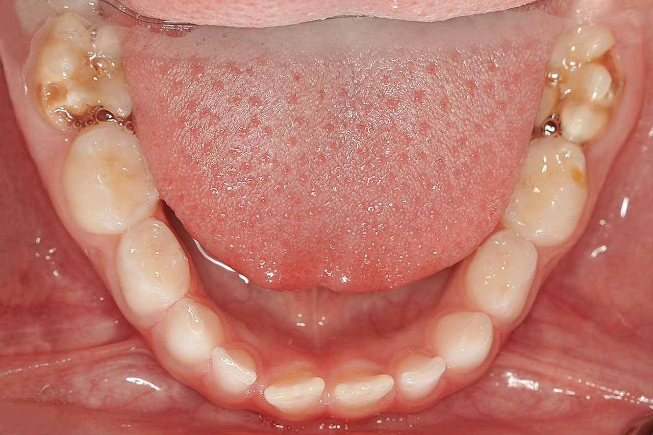 Abb. 2 Unterkiefer mit starker Zerstörung der Zähne 36 und 46 durch MIH.