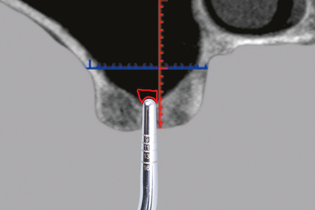 Abb. 14 Schematische Darstellung der Regio 16 im koro­nalen Schnittbild. Position des Osteotoms ca. 1 mm im Sinus. Der frakturierte Sinusboden wird in den Sinus gehoben.