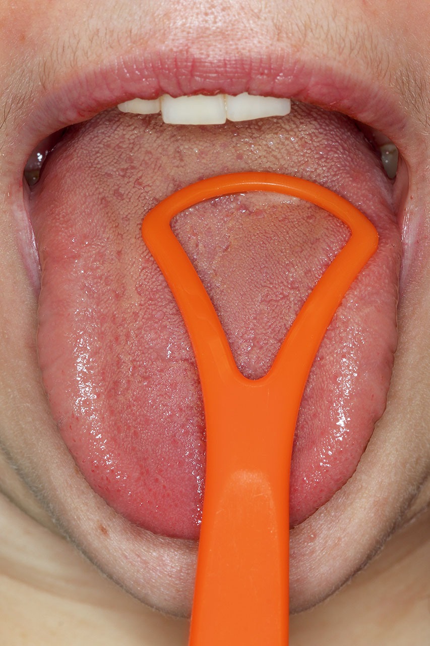 Abb. 5 Anwendung eines Zungen­schabers auf dem Zungenrücken ...