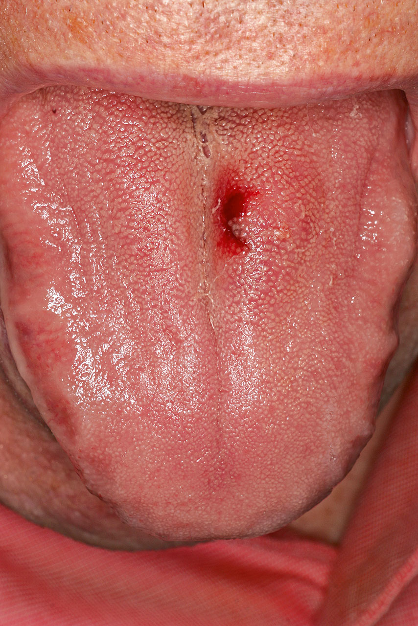 Abb. 1  Zentrales, in der Zunge liegendes, palpables Hämangiom nach Spontanblutung bei einem antikoagulierten Patienten mit seitlichen Zungenimpressionen.