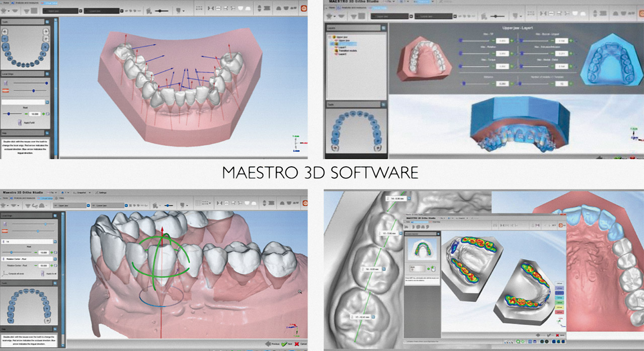Abb. 6 Planung einer Zahnstellungskorrektur (Software Maestro 3D Dental Studio, AGE Solutions, Pontedera, Italien).
