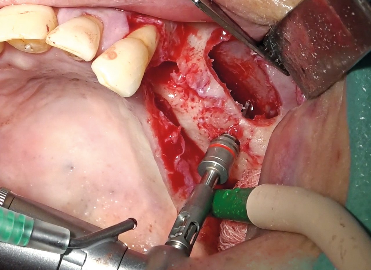 Abb. 5: Aufbereitung mit aufsteigenden Durchmessern. Man erkennt den 4,3-Millimeter-Formbohrer im Bereich des Sinus maxillaris.