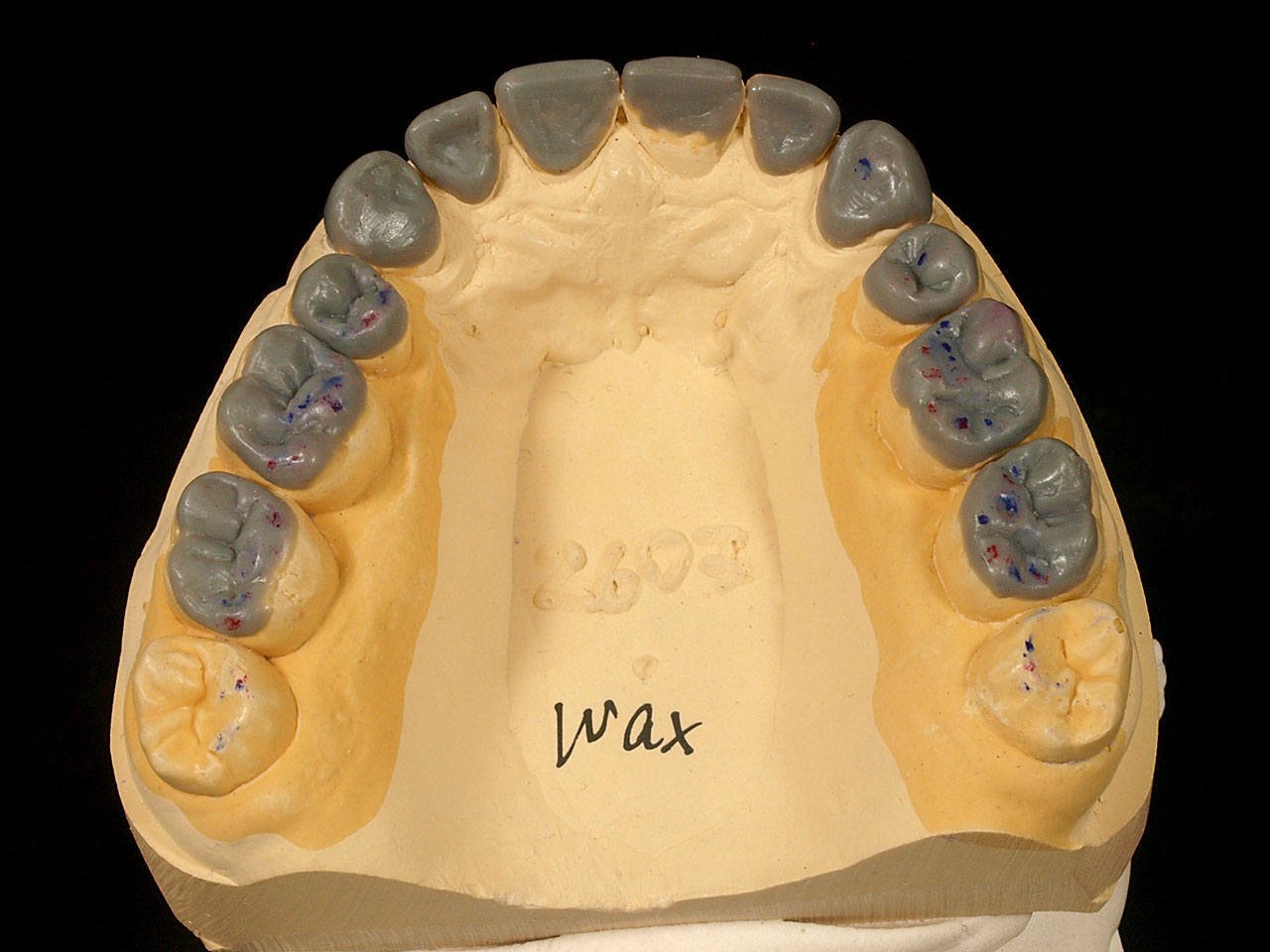 Abb. 12a Dreidimensionale Behandlungssimulation (Wax-Up) zur Versorgung der Kauflächen mit definitiven non- bzw. minimalinvasiven Keramikrestaurationen unter Wiederherstellung der vertikalen Dimension (Thowax, Fa. Yeti Dentalprodukte, Engen).