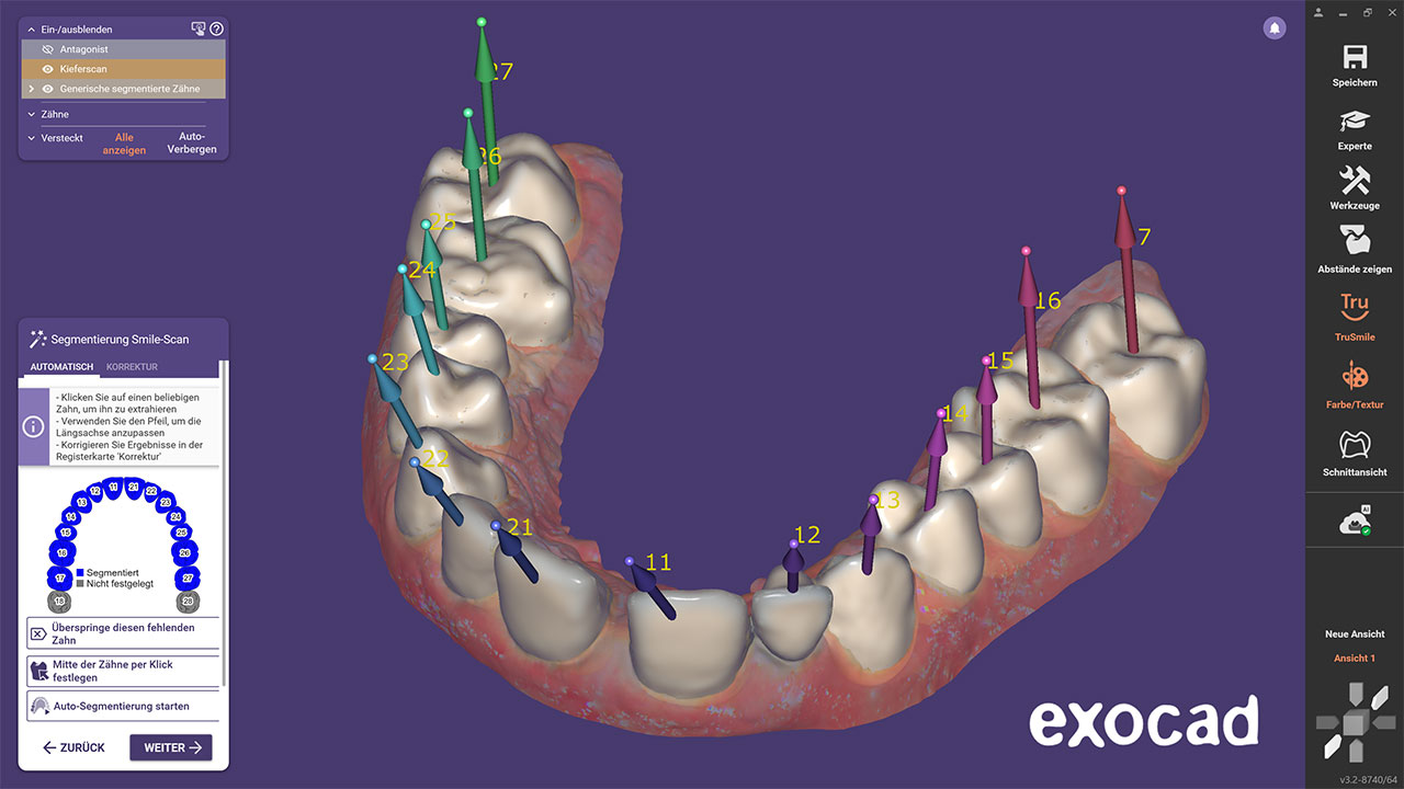Abb. 1 Mit Version 3.2 Elefsina ist die Möglichkeit zur automatischen Zahnsegmentierung dazugekommen. Zähne und Zahnfleisch werden auf dem Scan erkannt und segmentiert, für mehr Möglichkeiten in der Konstruktion und Visualisierung.