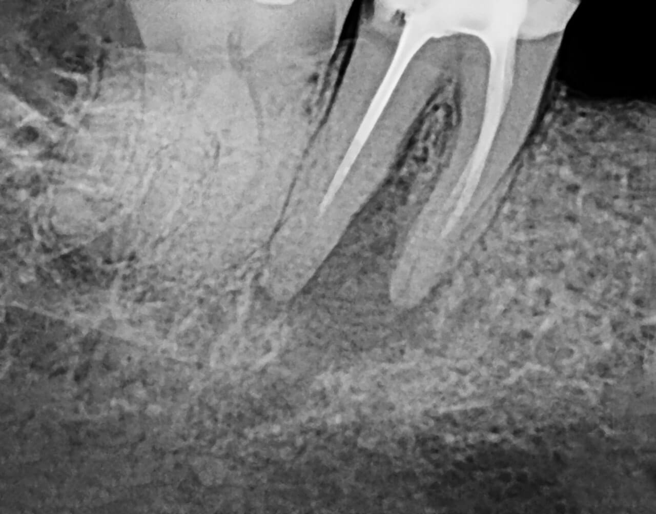 Abb. 1 Bild vor der Erstrevisionsbehandlung alio loco mit apikaler Aufhellung an Zahn 47 im Jahr 2016.