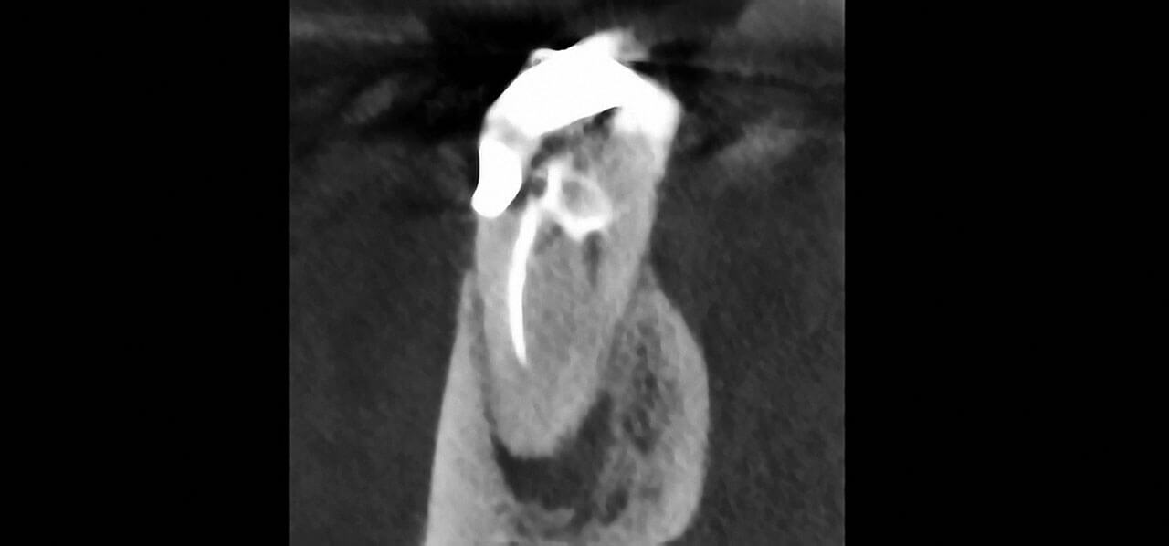 Abb. 3  DVT: Der Schnitt durch die me­siale Wurzel zeigt die apikale Aufhellung. Im mesiobukkalen Kanal findet sich eine ca. 4 mm zu kurze Wurzelfüllung; der mesiolinguale Wurzelkanal ist nicht gefüllt (April 2019). 