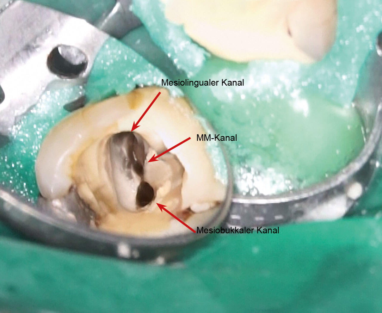 Abb. 5  Darstellung der Wurzelkanäle in der mesialen Wurzel; von oben nach unten: mesiolingual, „middle mesial“ (MM) und mesiobukkal.