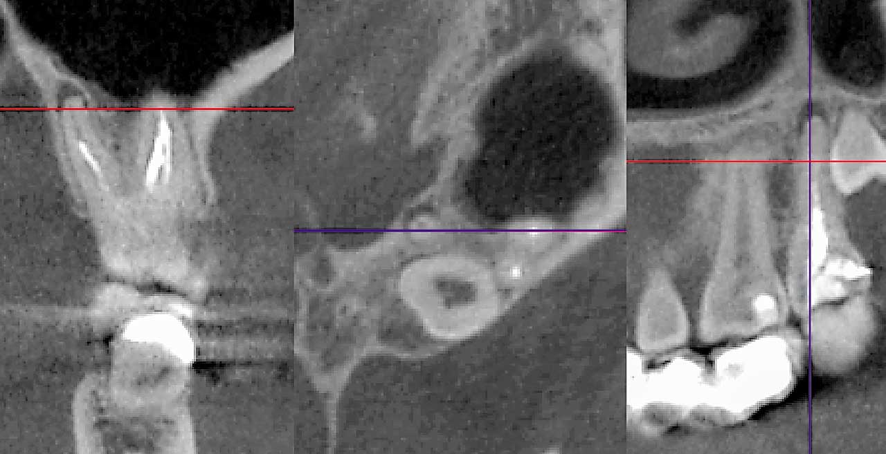 Abb. 3 DVT (koronal, axial, sagittal) mit zweitem Oberkiefermolaren, Zustand nach Wurzel­kanalbehandlung/Wurzelfüllung mit apikaler Parodontitis an der palatinalen Wurzel. Bei vestibulärem Zugang verhindern die bukkalen Wurzeln, der Sinus maxillaris sowie der verlagerte retinierte Weisheitszahn einen direkten Zugang. Hier wäre ein selektiver Eingriff mit palatinalem Zugang vorzuziehen.