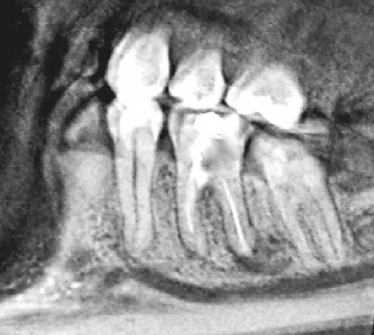 Abb. 4 Sagittales Schnittbild (DVT) Zahn 36 mit apikaler Parodontitis an beiden Wurzeln, Zahn 35 mit direktem Kontakt zum Foramen mentale und Zahn 37 mit Kontakt zum Nervus alveolaris inferior.