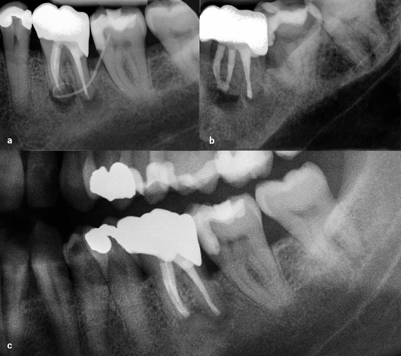 Abb. 5a bis c Zahn 36 mit per­sistierender apikaler Parodontitis (a). Auf dem postoperativen Röntgenbild (exzentrisch) nach WSR ist die isthmale Verbindung zwischen den beiden mesialen Kanälen nach Präparation und retrograder Obturation zu erkennen (b). Ausschnitt aus einem OPG nach 6 Monaten mit deutlicher Heilungstendenz (c).