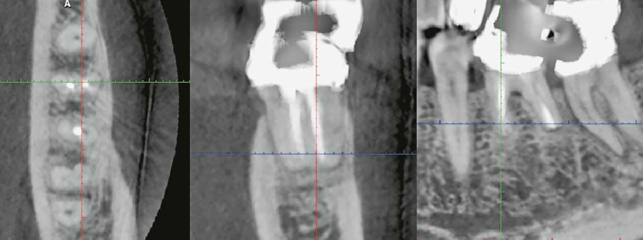 Abb. 6 DVT (axial, koronal, sagittal) mit einem Unterkiefermolaren, Zustand nach WSR an beiden Wurzeln. Eine komplette knöcherne Regeneration und Heilung sind zu erkennen. Hier wurden beide Wurzeln über eigene, separate Knochenfenster (Zugänge) behandelt.