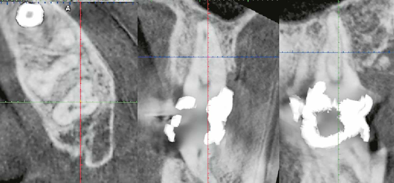 Abb. 7 DVT (axial, koronal, sagittal) von einem zweiten Ober­kiefermolaren mit fusionierten Wurzeln. Man beachte auch die Fusion der distobukkalen mit der palatinalen Wurzel am ersten Oberkiefermolaren.