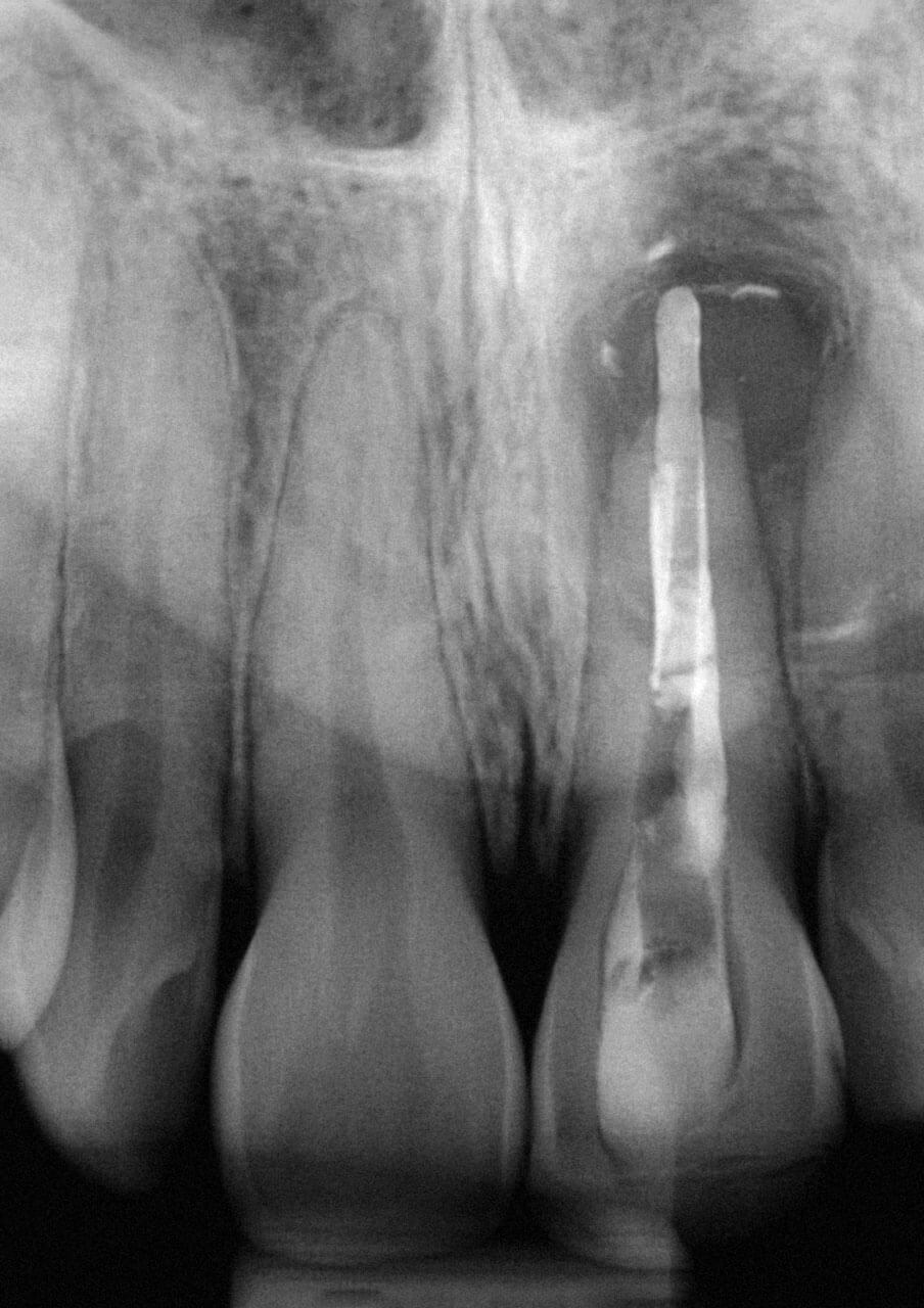 Abb. 2 Radiologische Ausgangs­situation bei Erstvorstellung nach bereits begonnenem Versuch der Revisionsbehandlung bei insuffizienter Wurzelfüllung und apikaler Läsion.