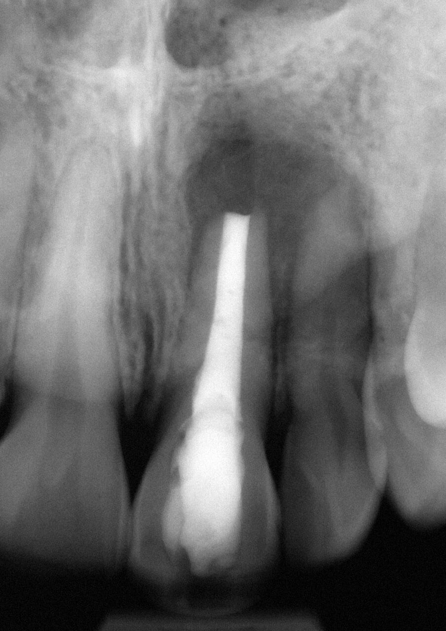 Abb. 13 Das postoperative Röntgenbild zeigt eine sauber resezierte Wurzelspitze und die erfolgreiche Entfernung des überpressten Wurzelfüllmaterials.