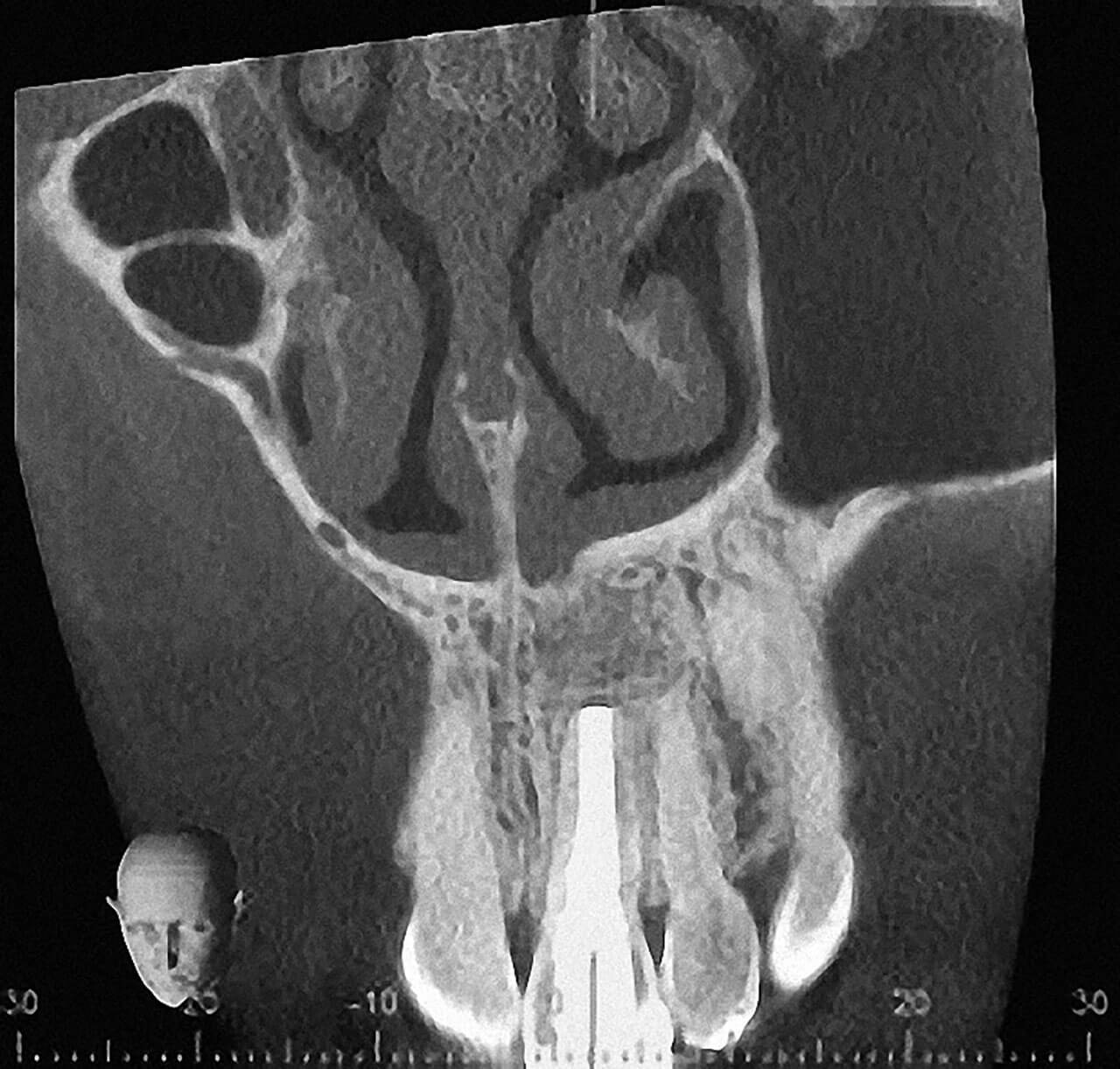 Abb. 16 und 17 Kontroll-DVT 12 Monate postoperativ: Vollständige knöcherne Regeneration des zystischen Defektes in Region 21.