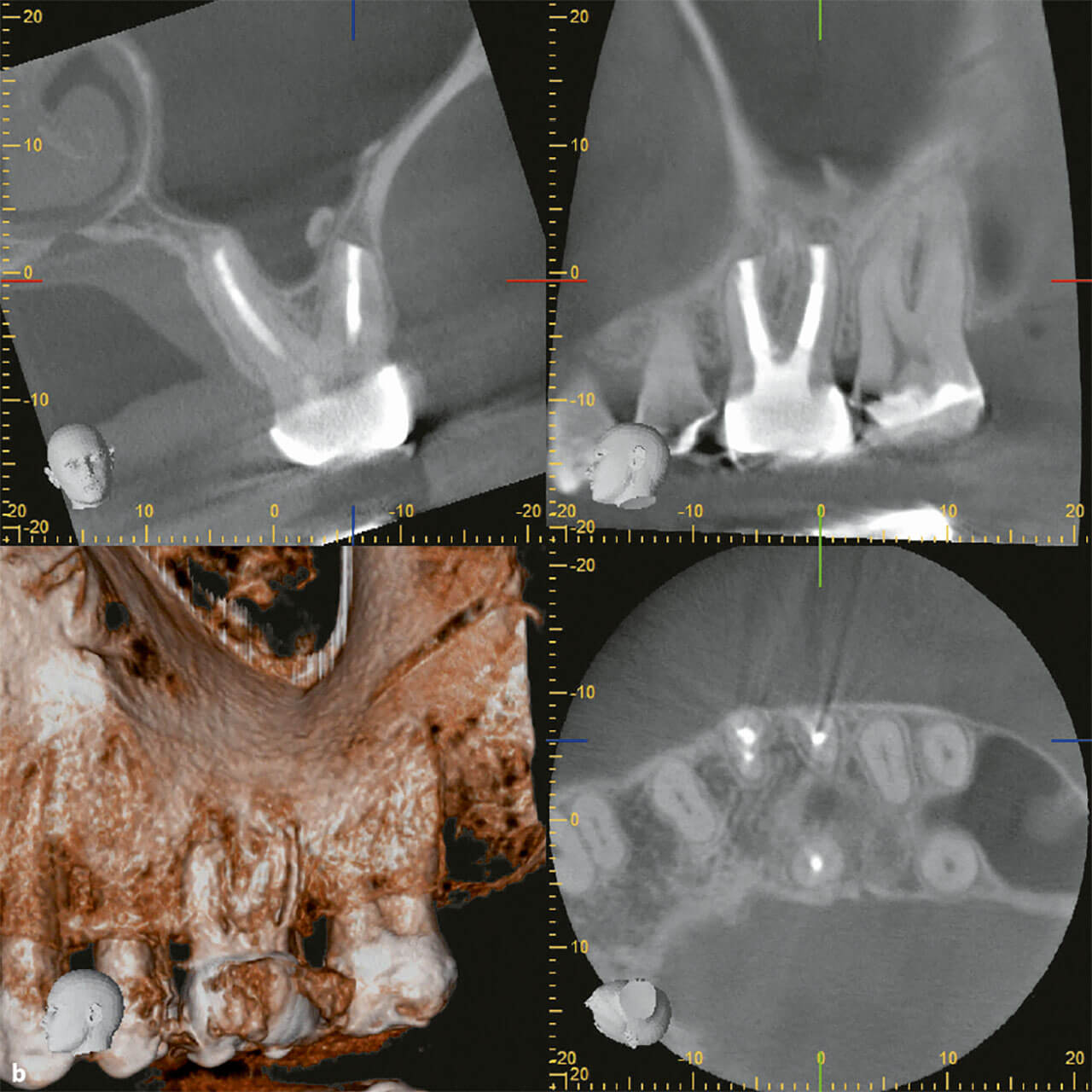 Abb. 5b In der koronalen Schnittebene ist die knöcherne Ausheilung an der Resektionsfläche der distobukkalen Wurzel zu erkennen. Die Schneider’sche Membran weist nun eine physiologische Schichtstärke auf.