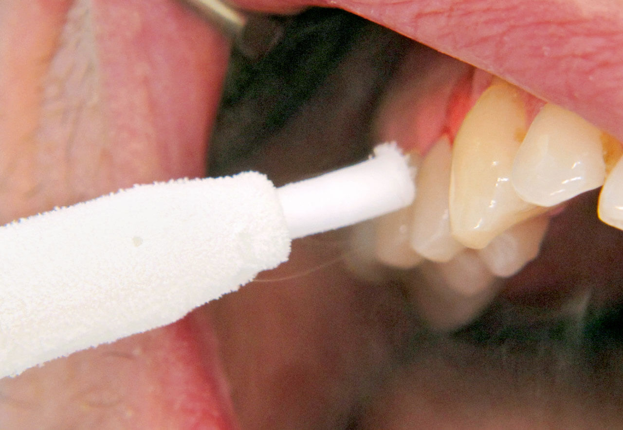 Abb. 2 Applikation von CO2-Schnee auf die Zahnoberfläche.
